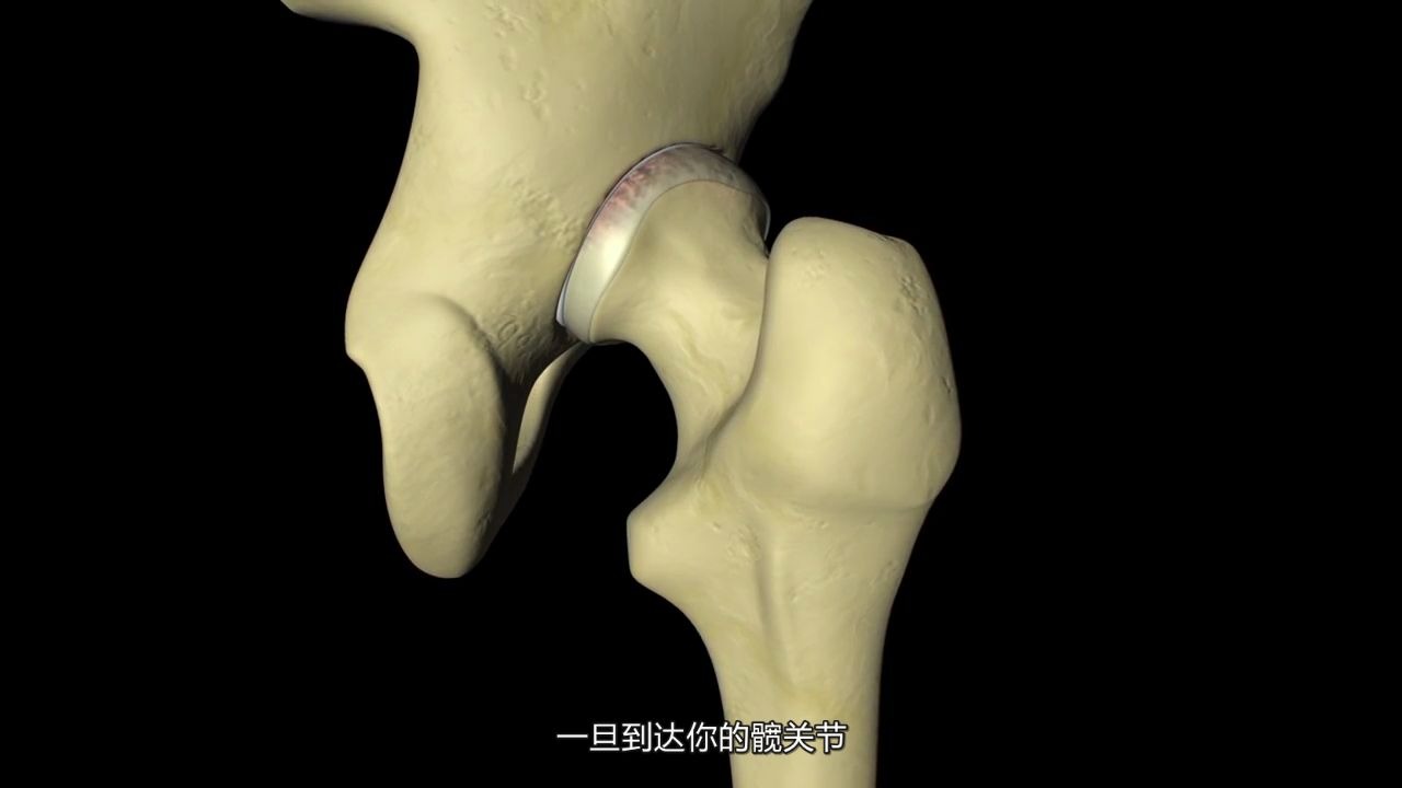 [图]【3D医学动画】髋关节置换术