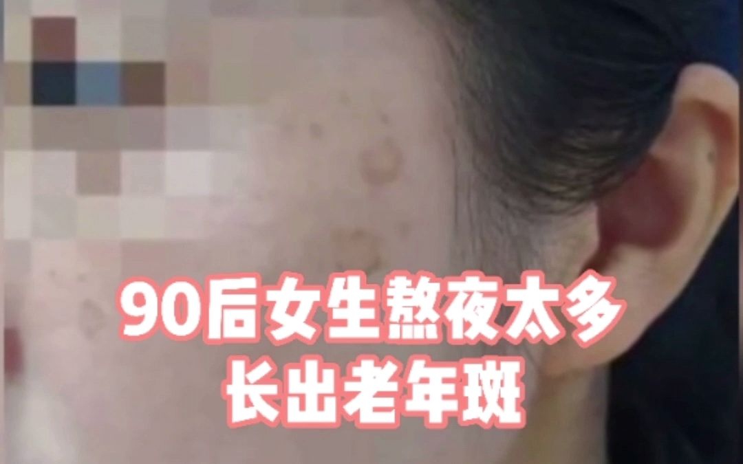 [图]90后女生熬夜10年长出老年斑：没在凌晨2点之前睡着过