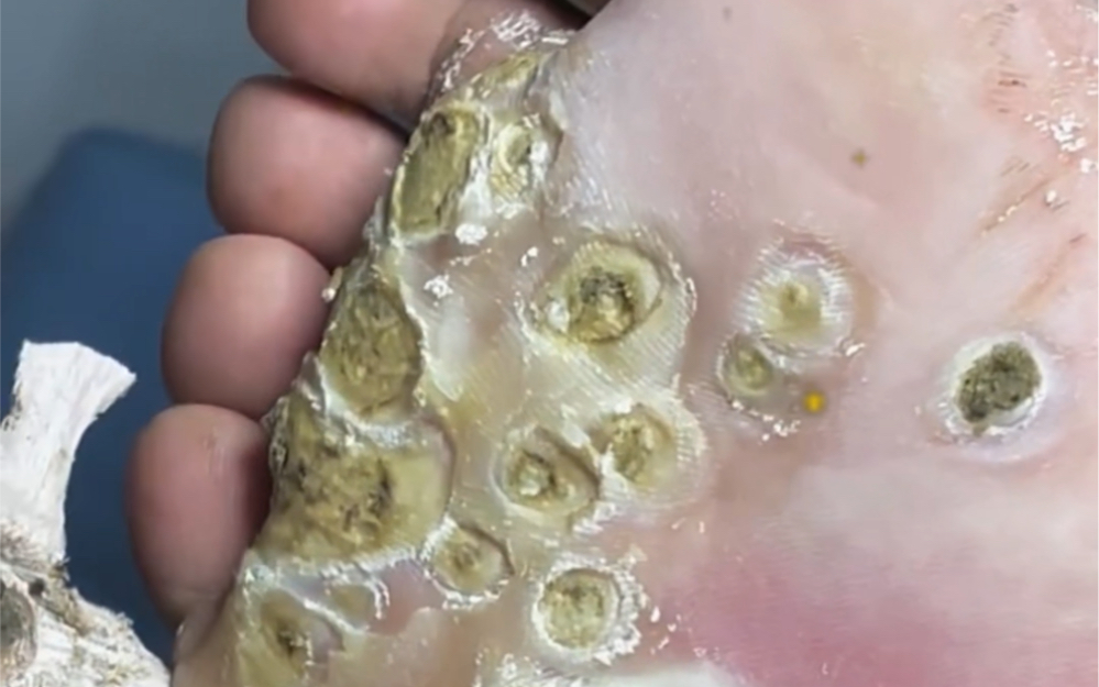 这脚上是长了个马蜂窝呀