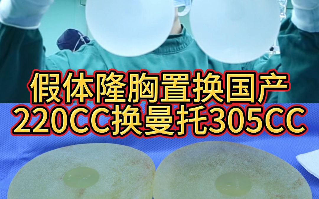 假体隆胸置换国产220CC换曼陀305CC哔哩哔哩bilibili