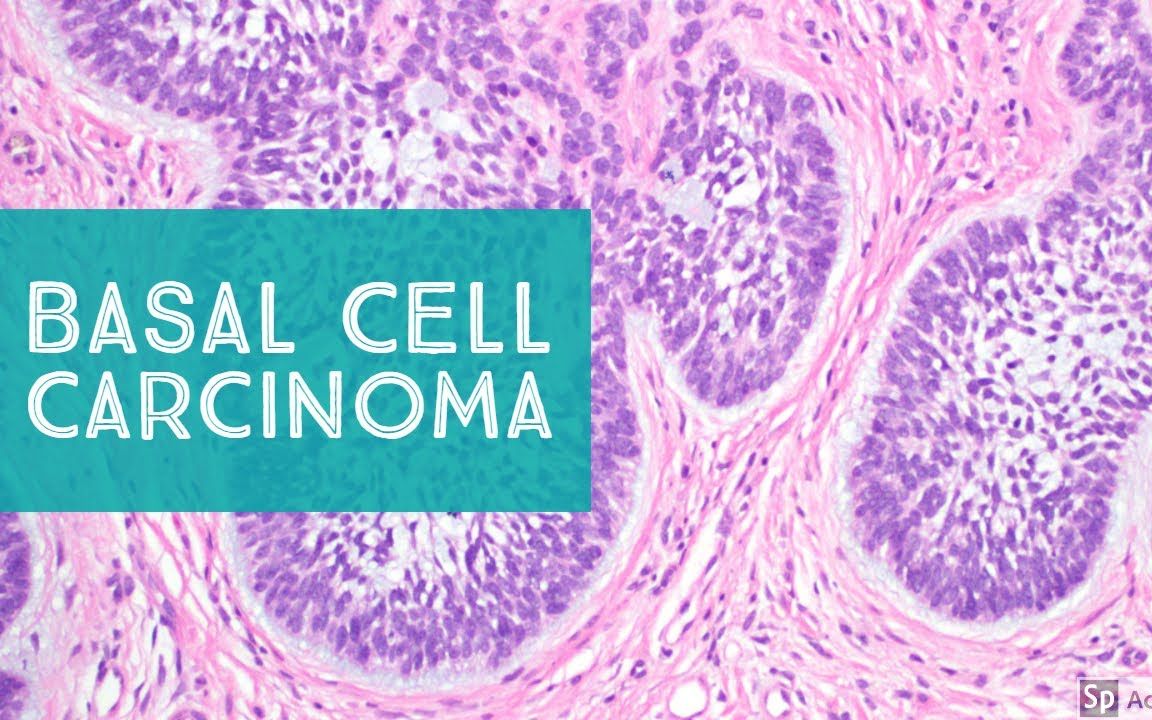 【皮肤病理】Basal Cell Carcinoma (BCC) 101哔哩哔哩bilibili