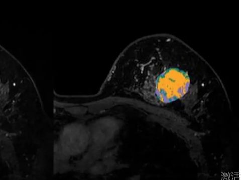 Fractal分析在乳腺癌影像特征提取中的角色是什么哔哩哔哩bilibili