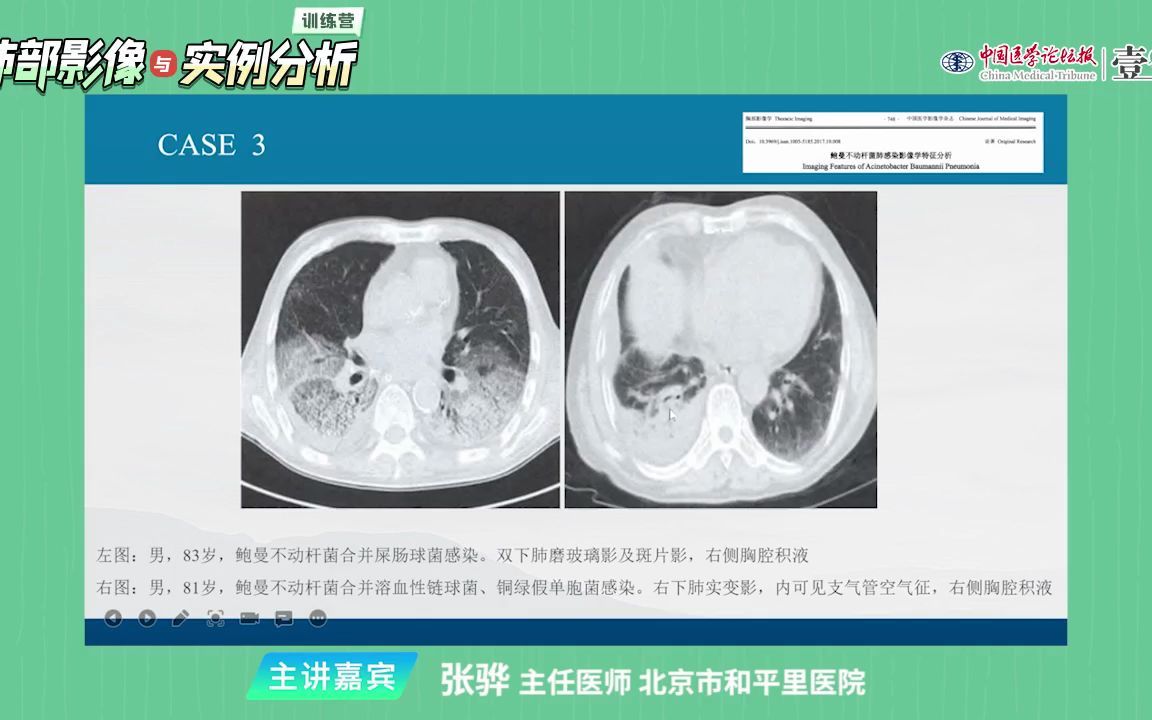 10鲍曼不动杆菌感染病例影像与临床解析哔哩哔哩bilibili