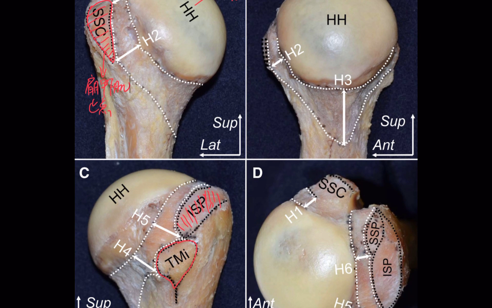 肩袖,肱骨近端,肩关节的解剖!涉及肩关节疼痛,肩周炎,肩袖损伤,肩关节脱位.骨折等话题哔哩哔哩bilibili