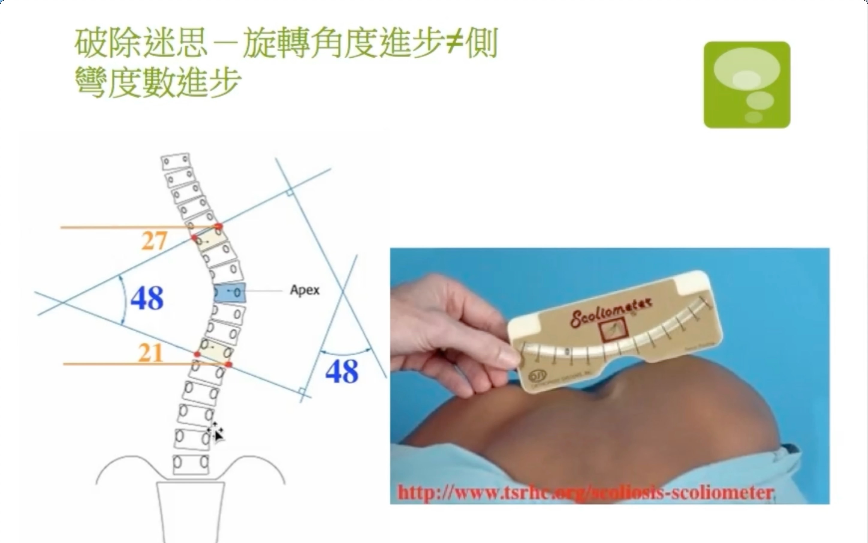 阎晓华说侧弯第三章:如何测量脊柱侧弯旋转角度哔哩哔哩bilibili