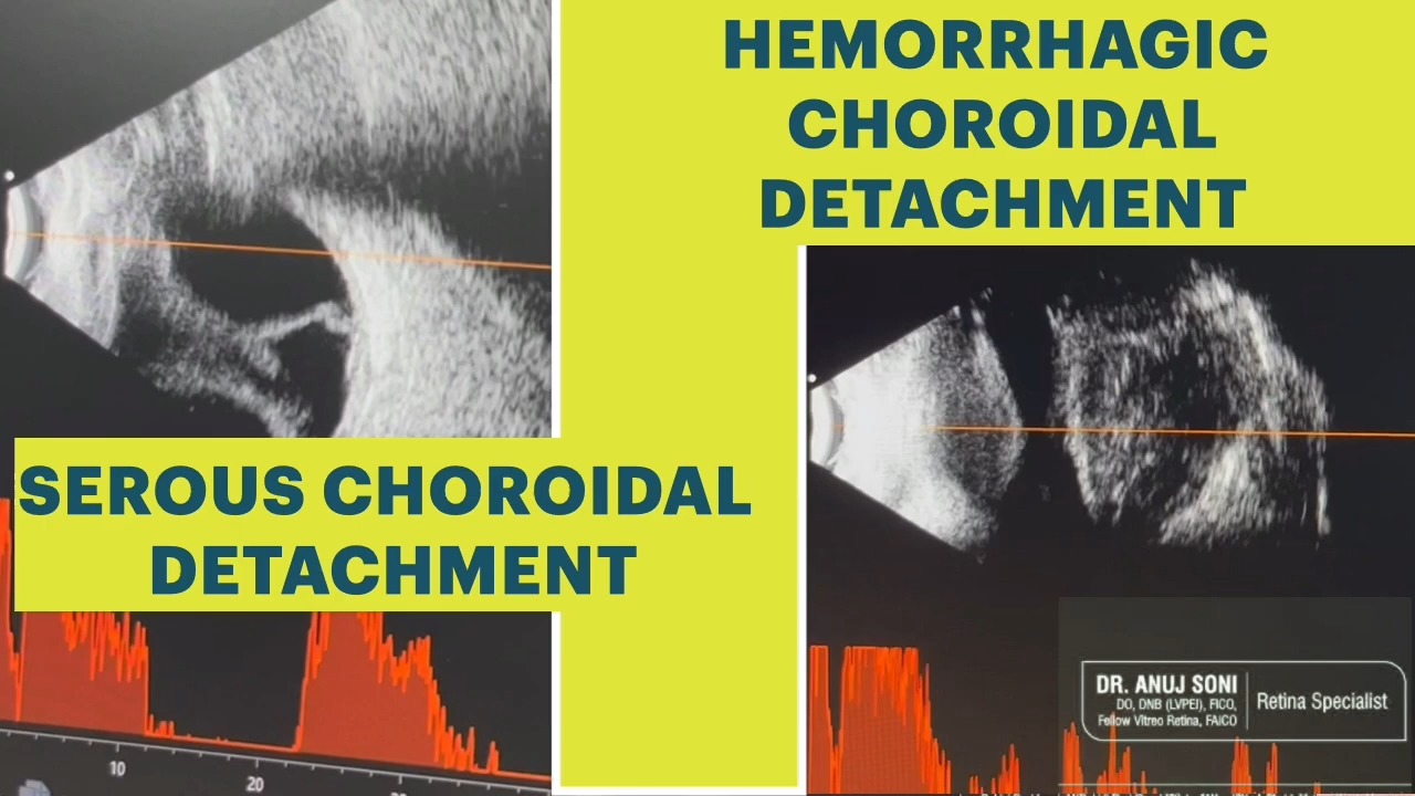 眼部b超:脉络膜脱离 | choroidal detachment : haemorrhagic vs
