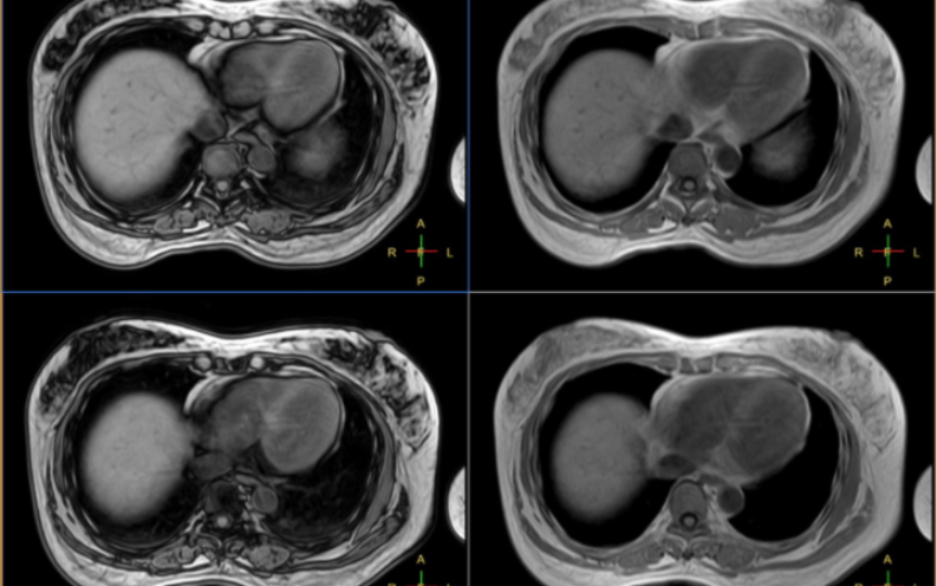 肝脏同反相位自由呼吸的扫描方法及2D和3D序列的区别哔哩哔哩bilibili