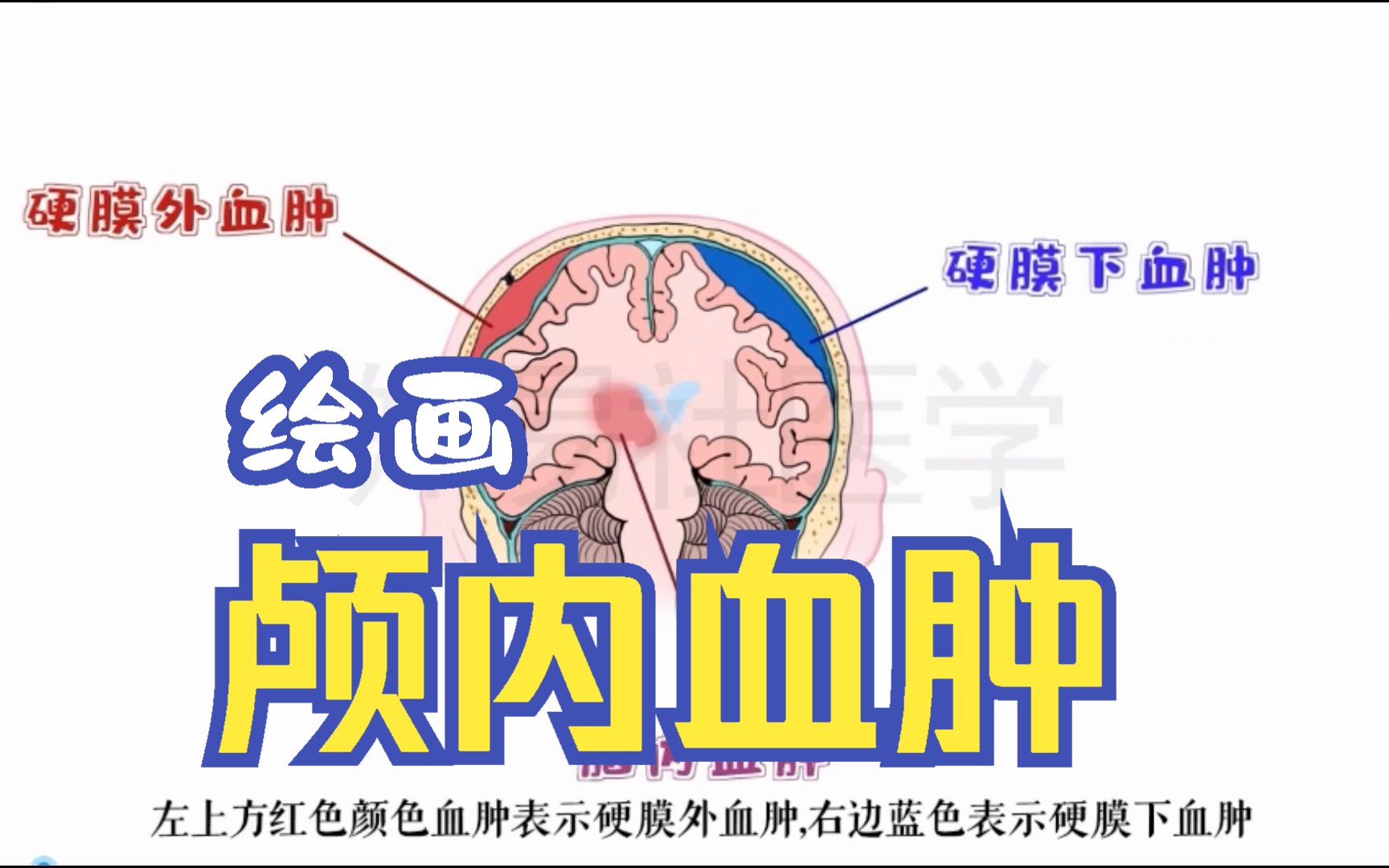 绘画 硬膜外血肿 VS 硬膜下血肿 VS 脑内血肿哔哩哔哩bilibili