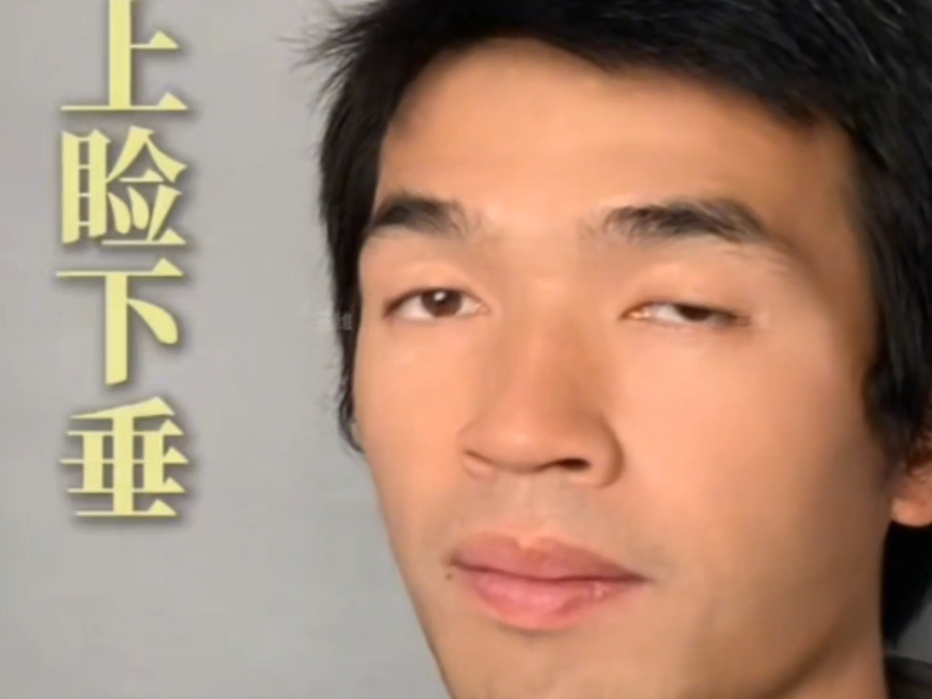 徐云做上睑下垂矫正，来看他术后的变化！