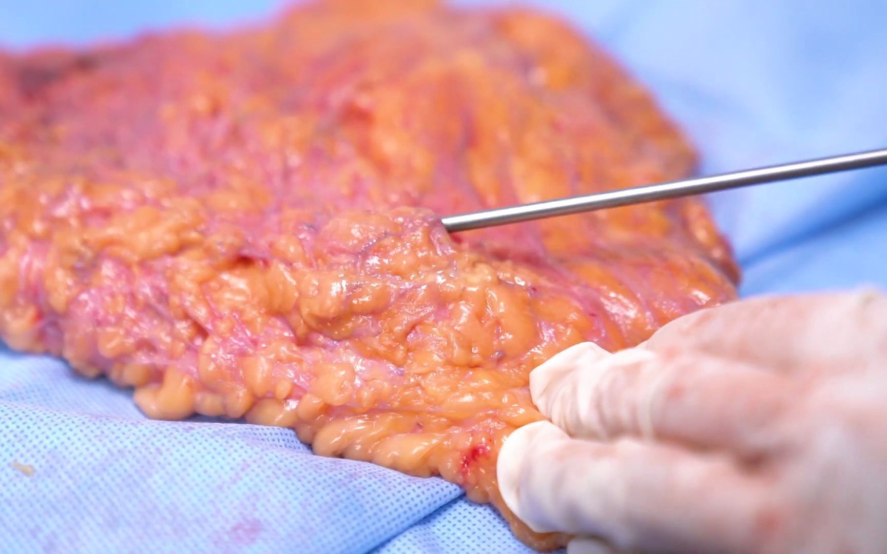 实物演示 吸脂脂肪溶解过程