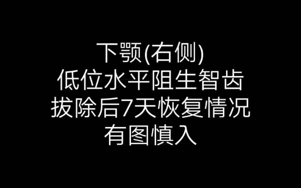 【实拍慎入】低位水平阻生智齿拔除后7天恢复情况哔哩哔哩bilibili