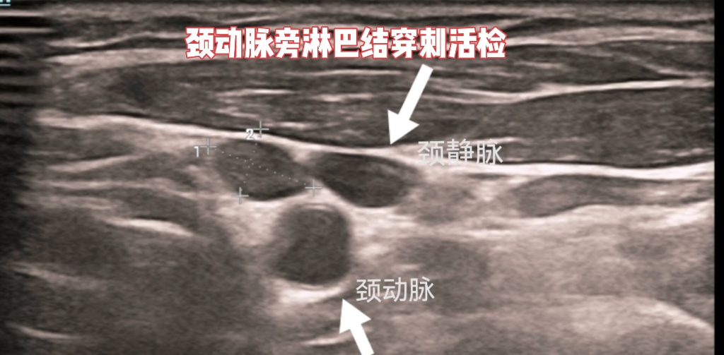 做有难度的介入~颈动脉旁淋巴结穿刺活检~哔哩哔哩bilibili