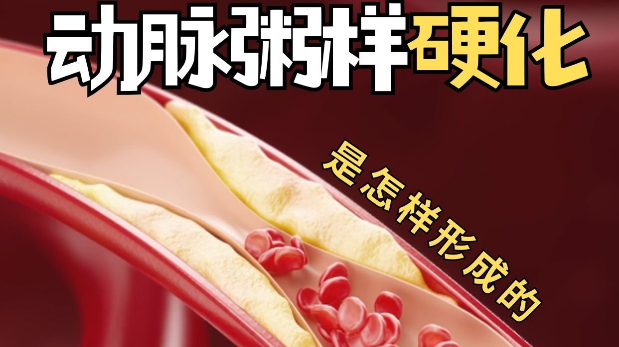 三维动画演示 | 动脉粥样硬化全过程