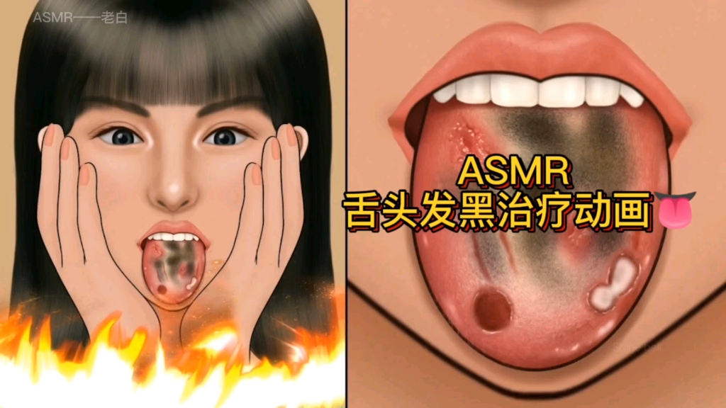 asmr 舌頭髮黑治療動畫