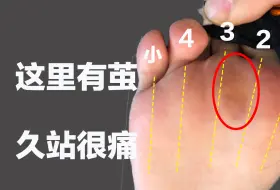 Tải video: 脚前掌有厚厚的茧子，久站很痛，这是足横弓塌陷，3步矫正改善【C戈】