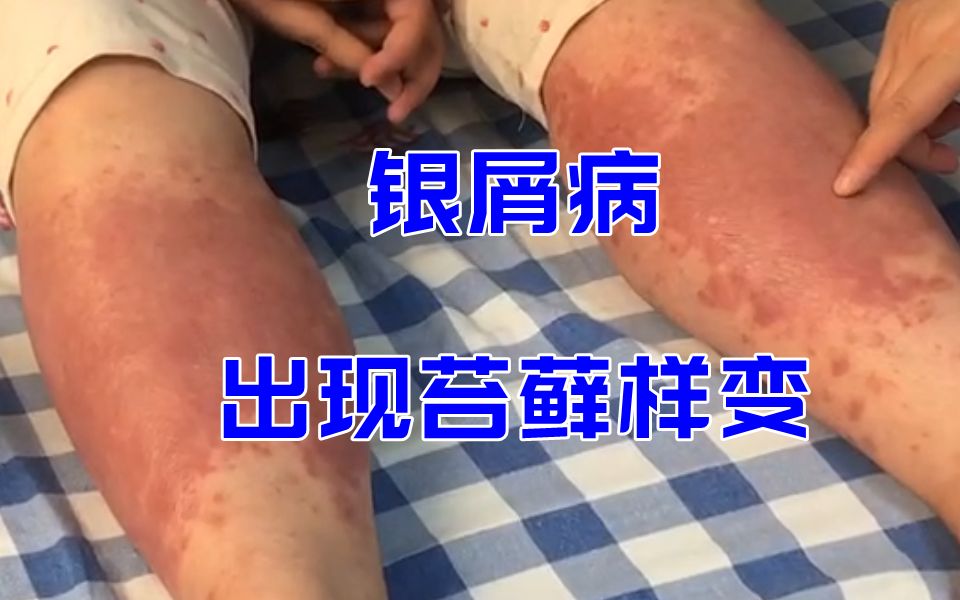 [图]患者腿部出现苔藓样变，告知患者为何会出现此情况