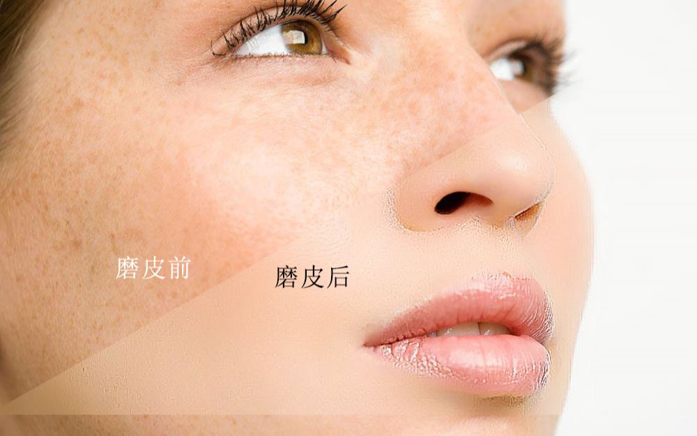 ps利用通道工具祛斑提亮脸部皮肤教程