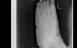 跖骨骨折 搜索结果 哔哩哔哩 Bilibili