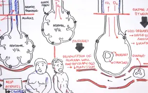 Video herunterladen: 慢性阻塞性肺疾病（ COPD / 慢阻肺 )  PART I