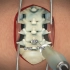 这手术太反人类了，腰椎间盘突出传统开放手术过程，3D演示。。