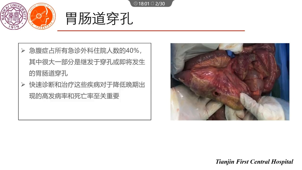 腹腔积气的影像定位与诊断沈文哔哩哔哩bilibili