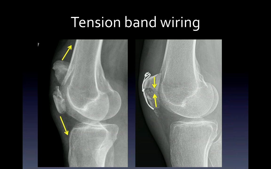 [图]1ISS132 Weissman – Orthopaedic Imaging Principles of Fracture Fixation