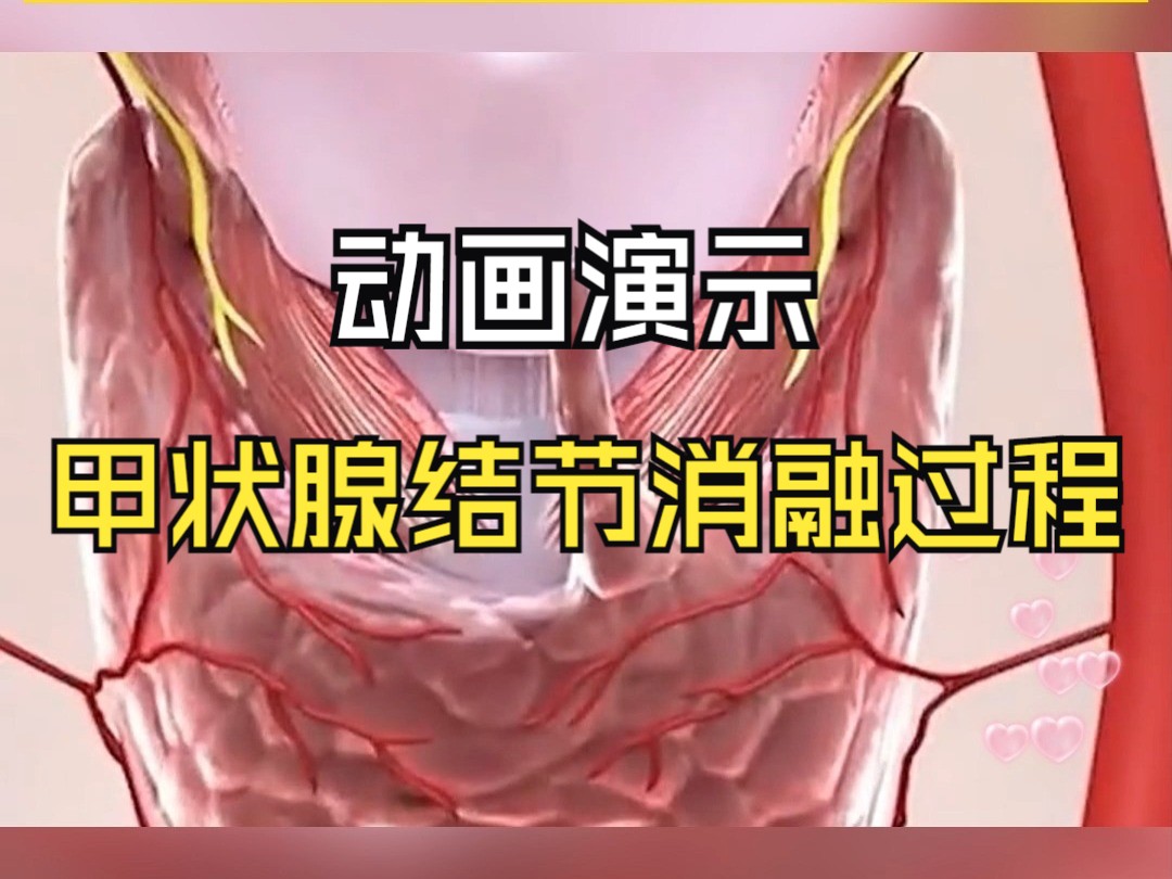 动画演示:甲状腺结节消融的过程哔哩哔哩bilibili