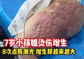 Tải video: 8次点阵激光让烫伤增生越长越大，小孩姐受了两年的罪