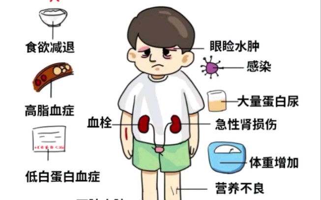 肾病综合征的临床表现