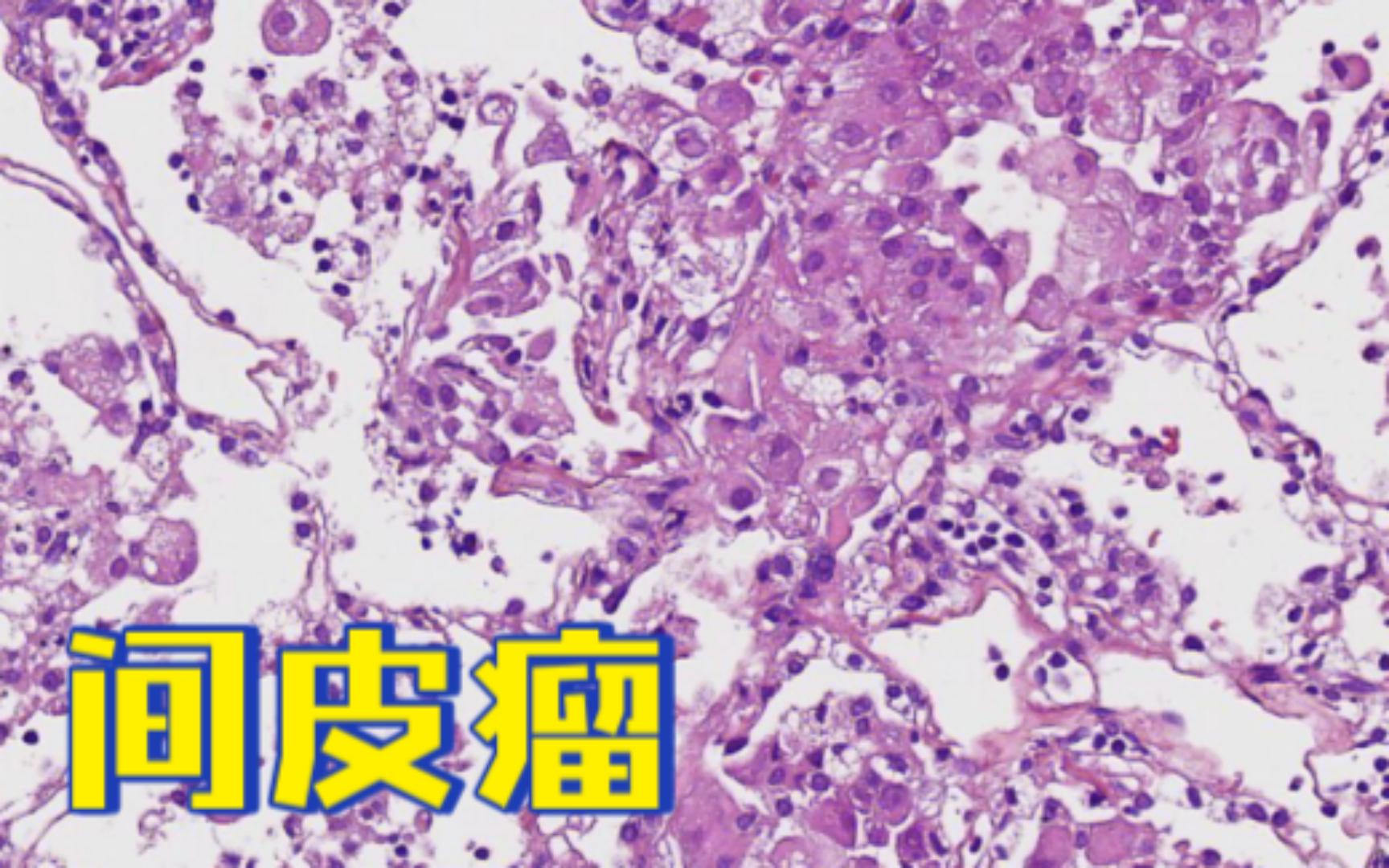 【病理56】男性67岁,肺部占位及胸膜增厚,间皮瘤哔哩哔哩bilibili