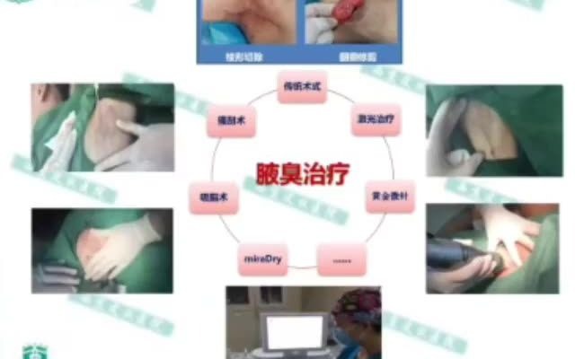 腋臭治疗策略西京皮肤病医院哔哩哔哩bilibili