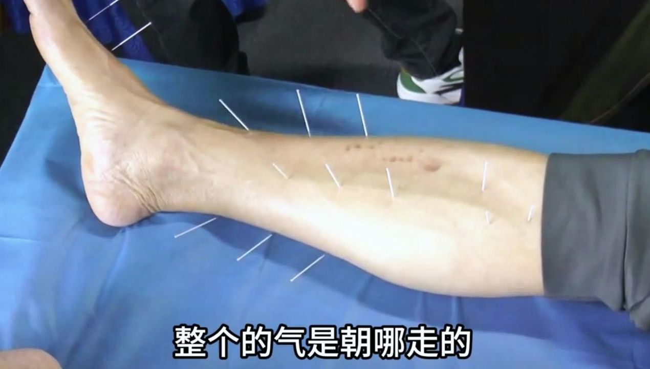 易水医方 舒卿:不管哪种程度的脑梗塞都怕中医这3招舒卿实操现场看