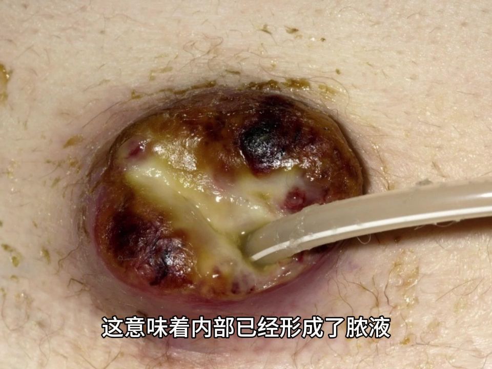 乳腺炎破溃图片图片