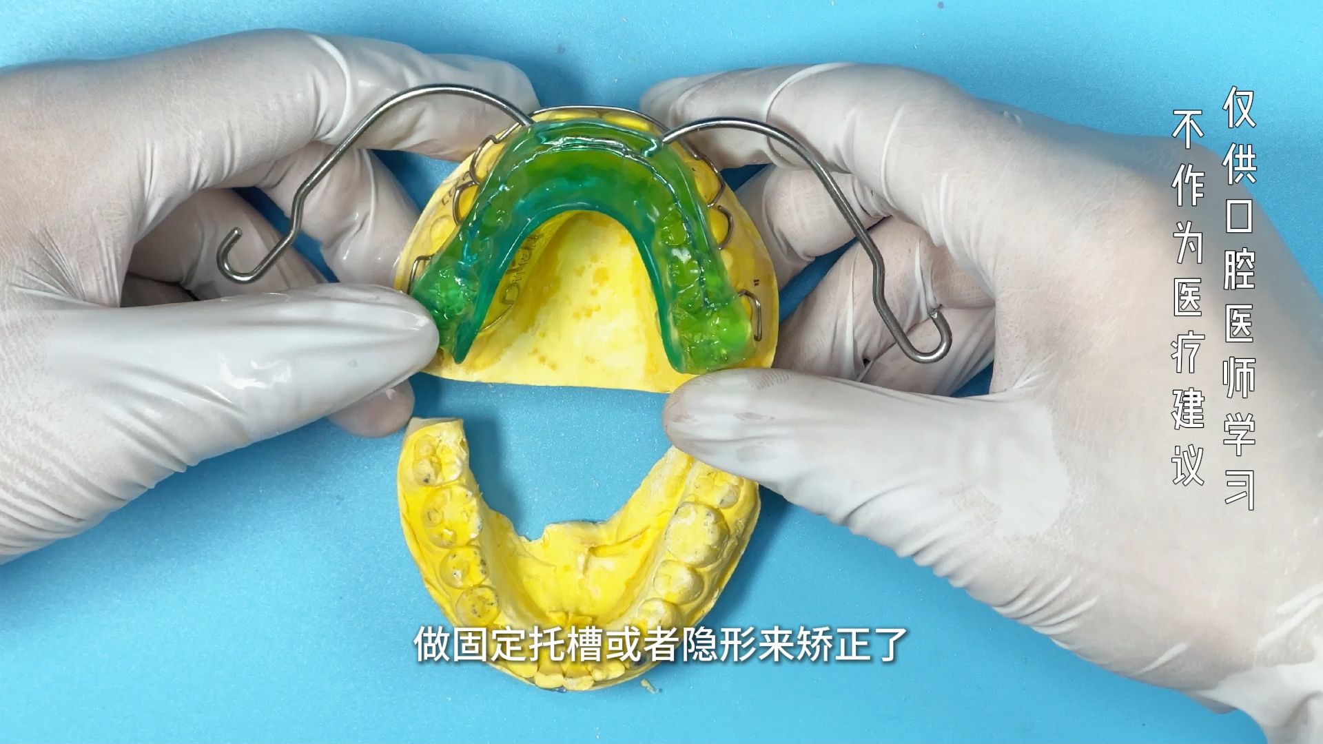 口外弓式的肌激动器 妃她正畸 儿童牙齿活动矫正器-妃她矫治器-妃她矫治器-哔哩哔哩视频