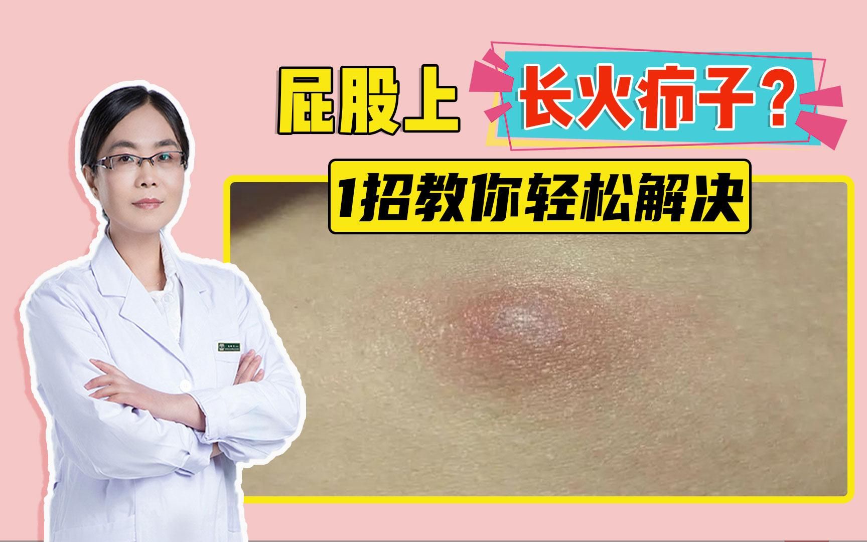 火疖子应该怎么治疗呢?