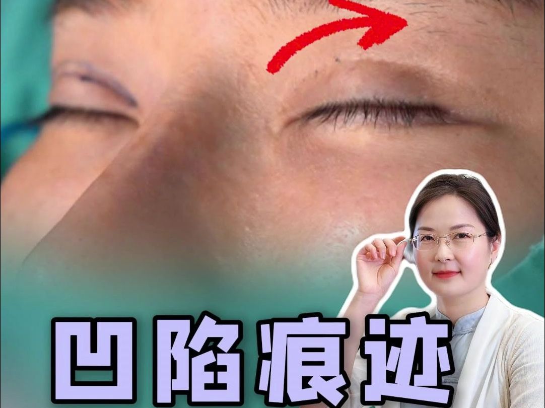 双眼皮嘎深了,闭眼痕迹深还有救❓
