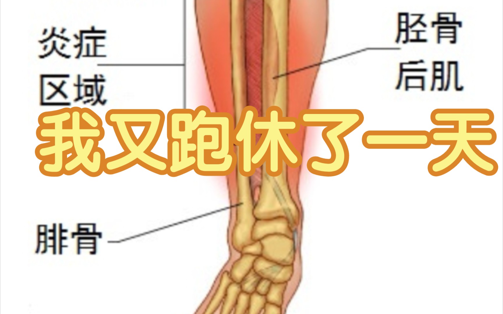 大家遇到胫骨疼是咋弄的?有没有啥好方法?哔哩哔哩bilibili