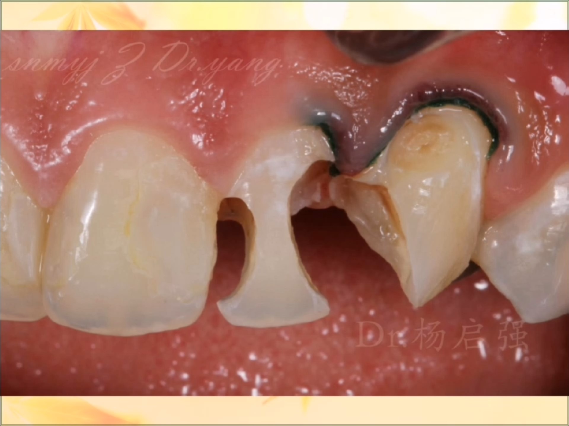 杨启强 前牙树脂美学修复 二