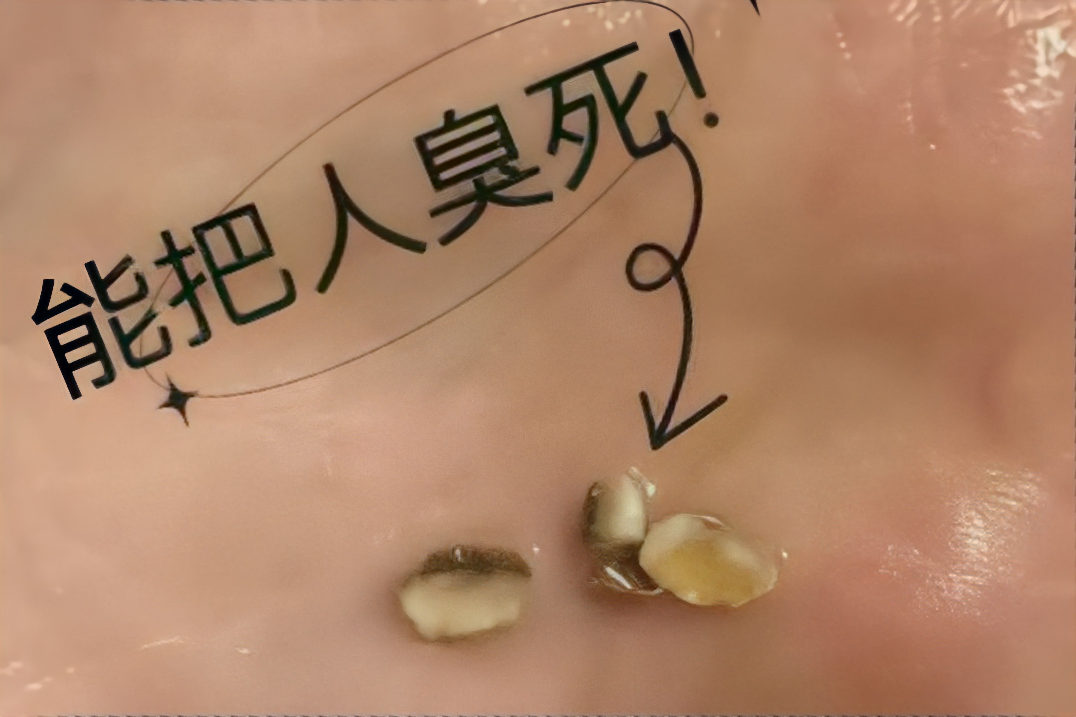 牙齿为什么会长结石