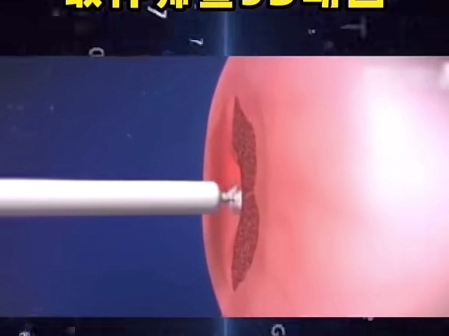 tcp,hpv取样筛查3d动画