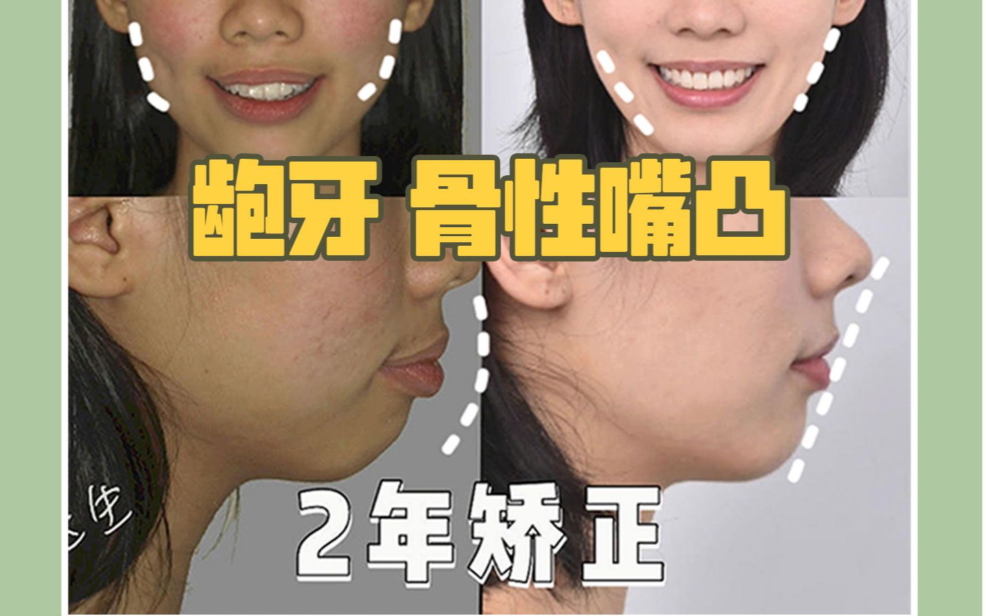 龅牙骨性嘴凸,2年矫正,女生的蜕变分享!哔哩哔哩bilibili