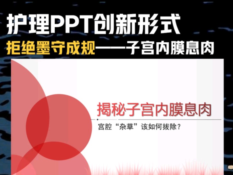 护理PPT创新形式!拒绝墨守成规——子宫内膜息肉!哔哩哔哩bilibili