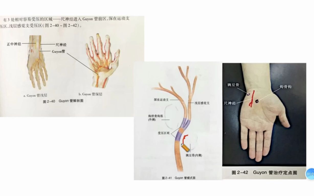 尺神經易損傷點guyon管定位及處理解析