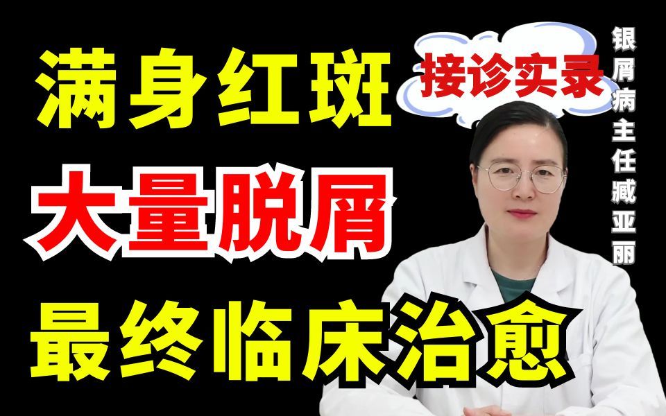 满身红斑、大量脱屑,终于达到临床治愈!哔哩哔哩bilibili