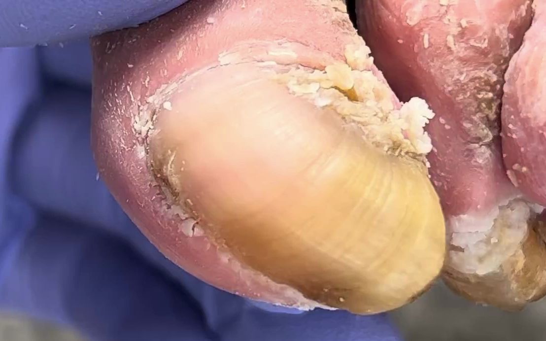 【灰指甲】这位女士的脚趾甲像蜗牛壳一样卷曲,专业修脚