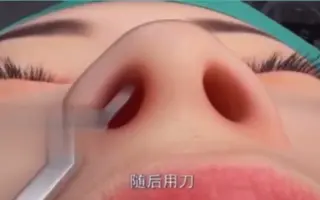 假体隆鼻动画全过程