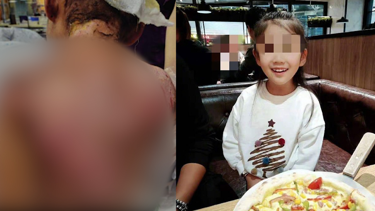 抚顺虐童事件追踪:治疗费用暂已筹够 生父和其视频时发现异常