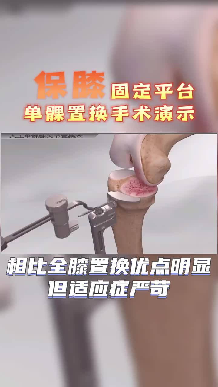 单髁置换手术演示哔哩哔哩bilibili