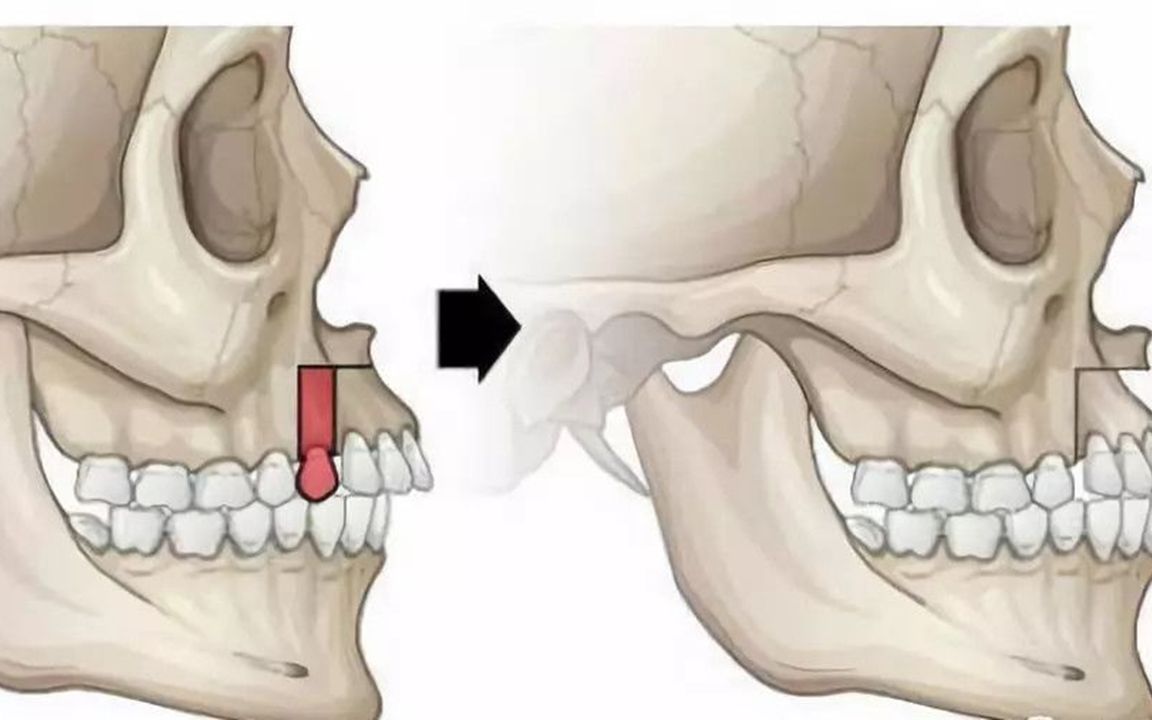 深圳牙齿矫正科普-骨性错颌畸形一定要进行正颌手术吗?