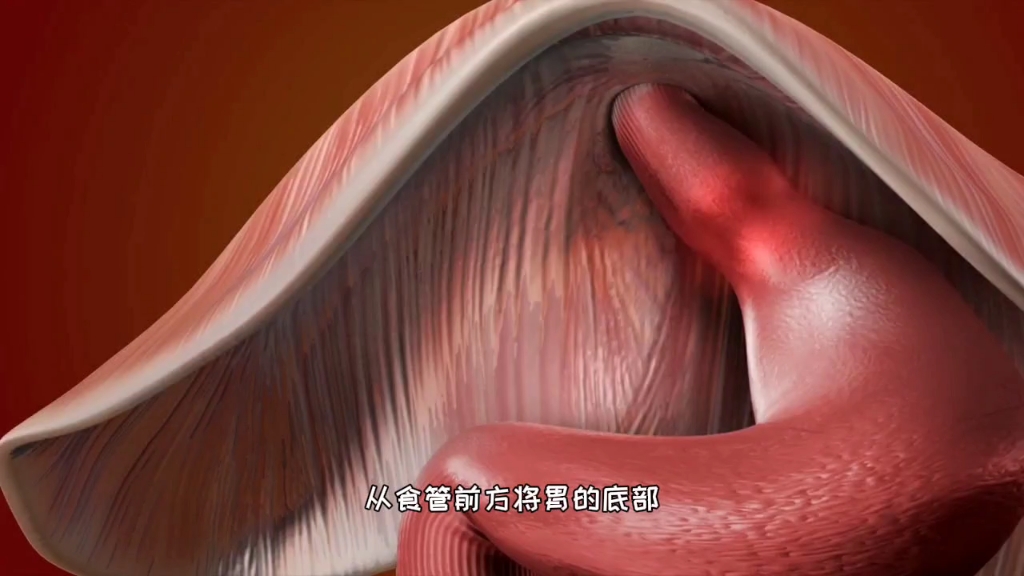 胃也可以对折,胃底折叠术治疗反流性食管炎,3d演示.